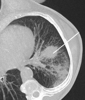 Röntgenbild flecken lunge weiße Streifenschatten